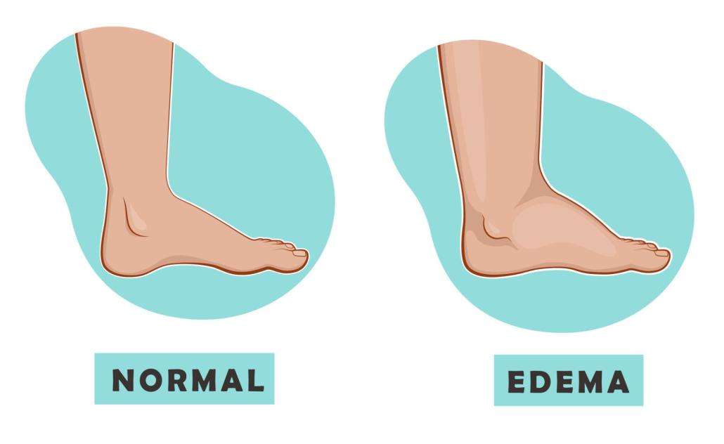 illustration comparing normal ankle and leg with edema swelling