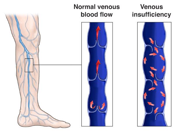 diagram comparing normal venous blood flow with venous insufficiency showing backward blood flow in leg veins