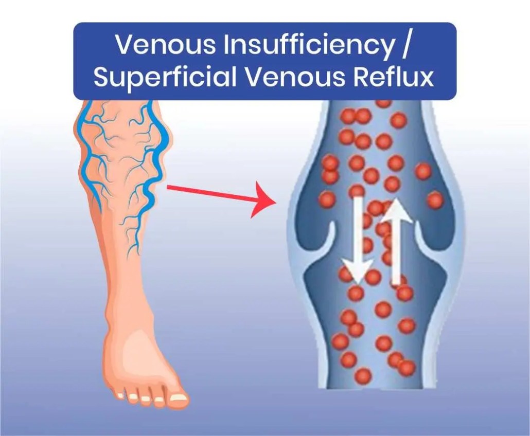diagram showing venous insufficiency and superficial venous reflux causing poor blood flow in leg veins