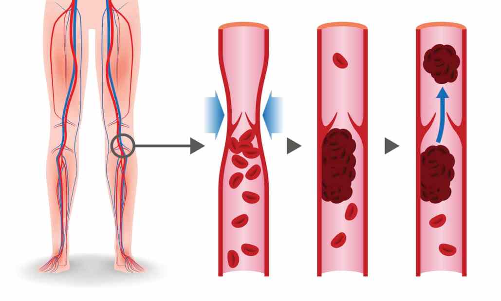 diagram showing deep vein thrombosis blood clot forming in a leg vein