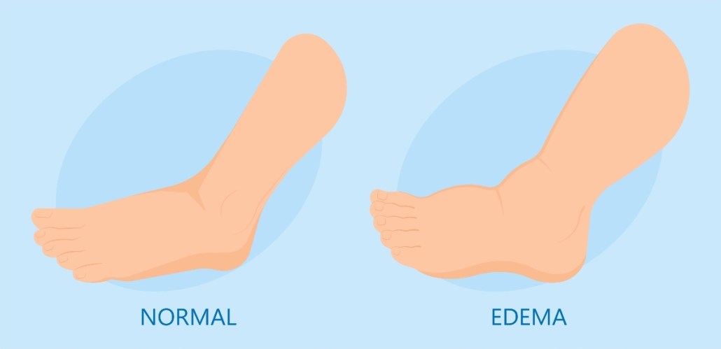 illustration comparing normal foot and swollen foot from edema