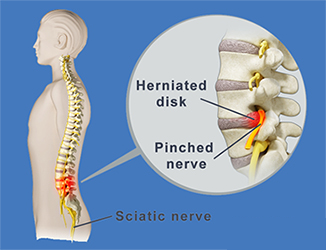 diagram showing herniated disc pressing on the sciatic nerve in the lower spine