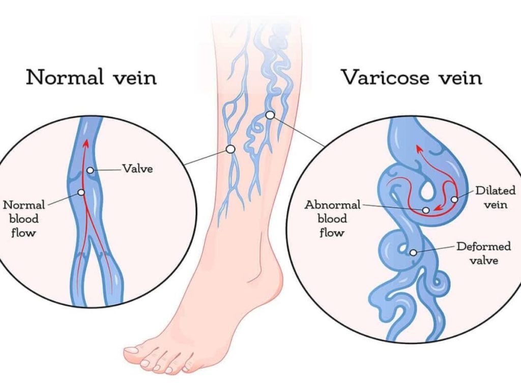 Normal Vein vs Varicose Vein Diagram diagram comparing normal vein blood flow and varicose vein with damaged valve