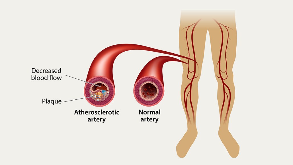 diagram showing peripheral artery disease with plaque causing reduced blood flow in leg arteries