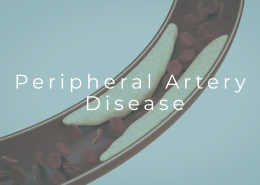 Medical illustration showing artery blockage in the legs from peripheral artery disease