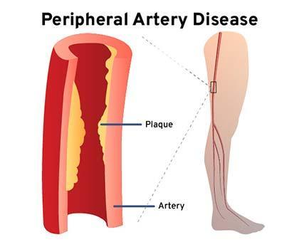 diagram showing plaque buildup in an artery causing peripheral artery disease