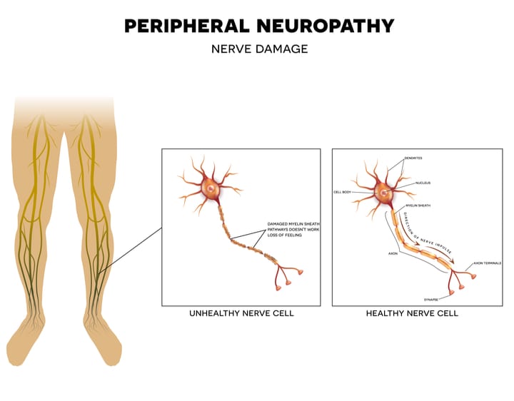 Peripheral Neuropathy Nerve Damage Comparison diagram comparing healthy nerve cell and damaged nerve cell in peripheral neuropathy