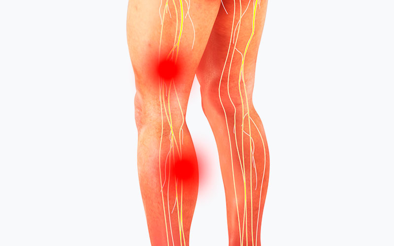sciatic nerve pain shown radiating down the leg from hip to calf