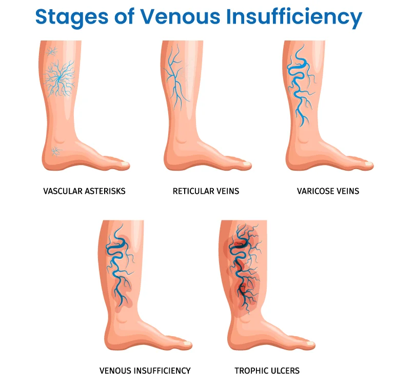 diagram showing stages of chronic venous insufficiency from spider veins to varicose veins and venous ulcers