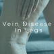 Medical illustration showing vein disease affecting blood circulation in the legs