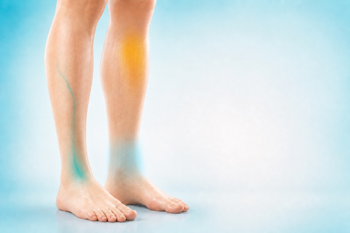 Same legs showing venous pooling, possible swelling, and muscle fatigue as separate possible contributors.