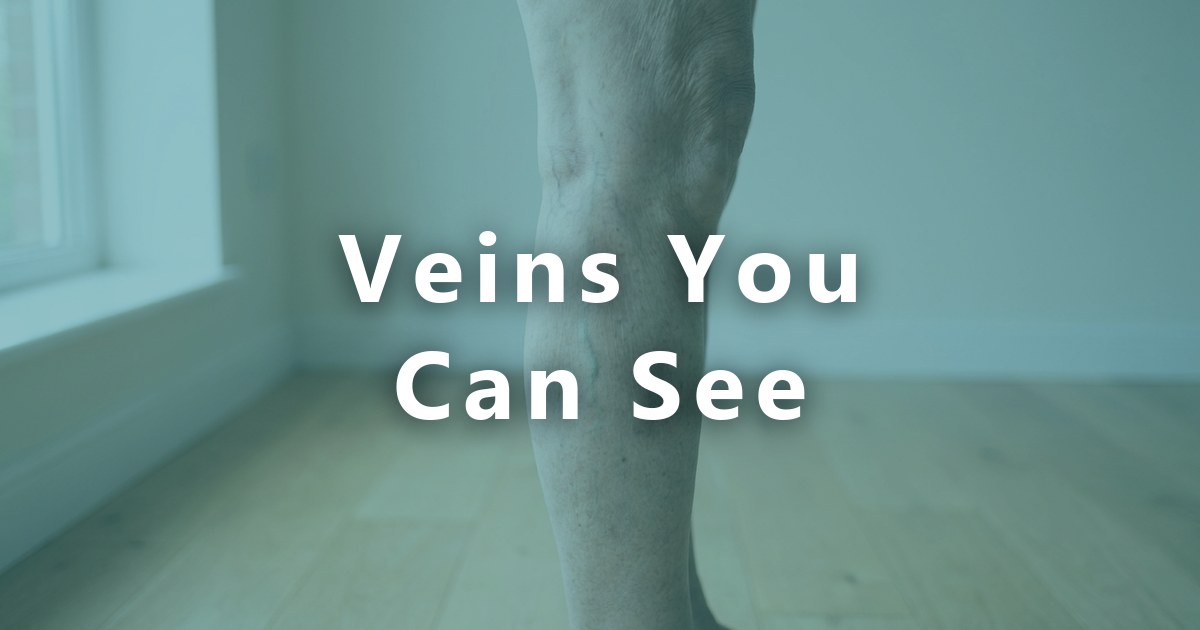 Varicose Veins vs Spider Veins: How to Tell What You Have